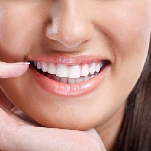 Inlay-Onlay and Overlay Fillings