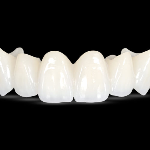 All-Ceramic Crowns