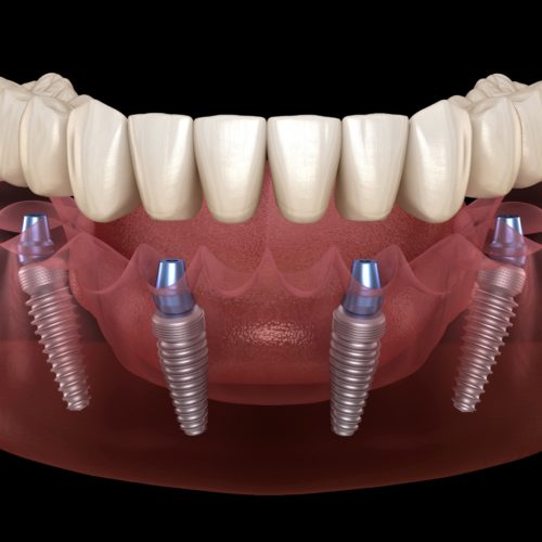 All-On-4 Dental Implants