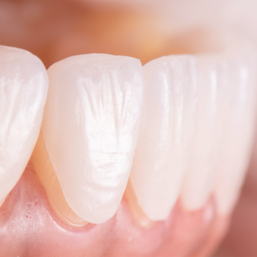 EMAX Laminate Veneers