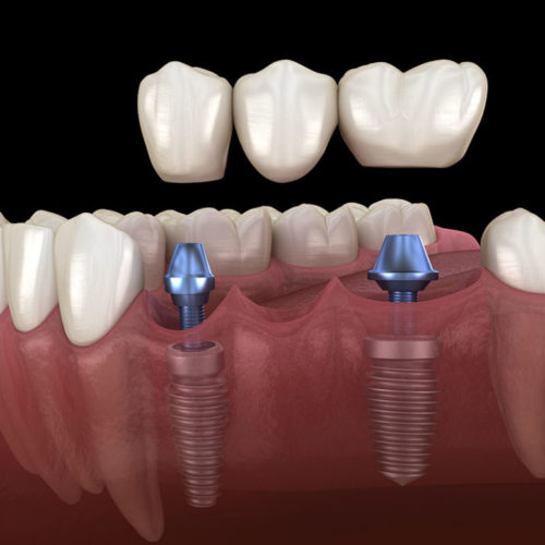 Implant Supported Dental Crown and Bridge