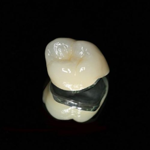 Porcelain – Metal Crowns