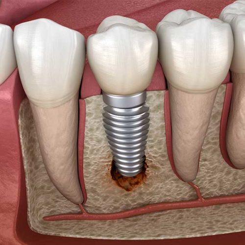 Dental Implant Failure & Salvage