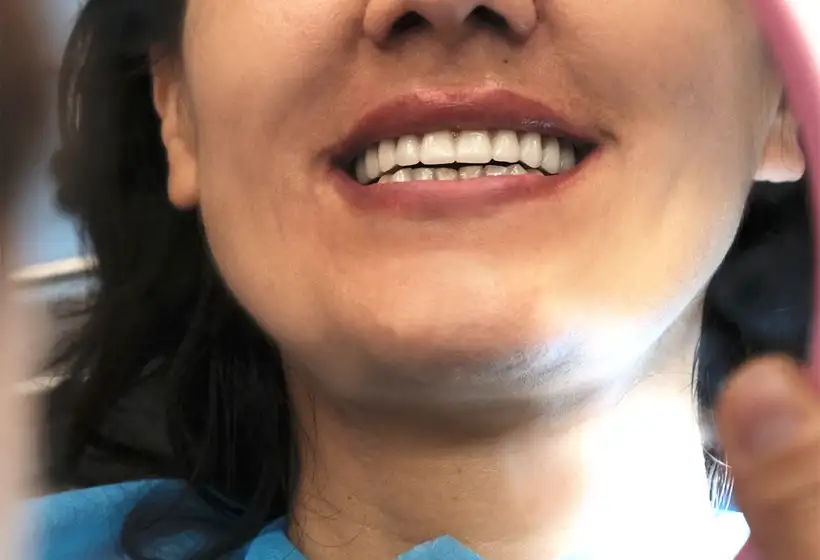 Types of Dental Veneers - Europedentalclinic com