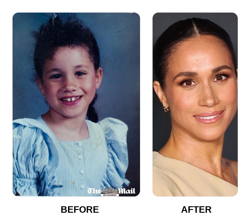 Does Meghan Markle have veneers on her teeth?
