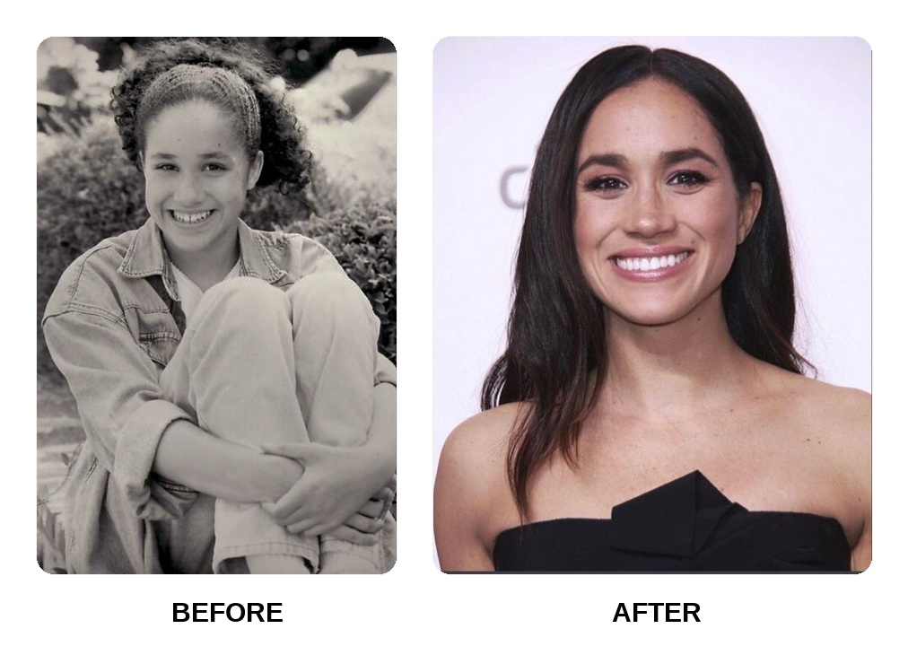 What happened to Meghan Markle teeth?