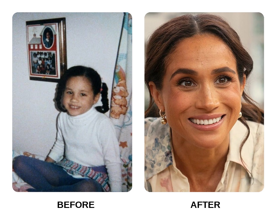 Did Meghan Markle get her teeth done?