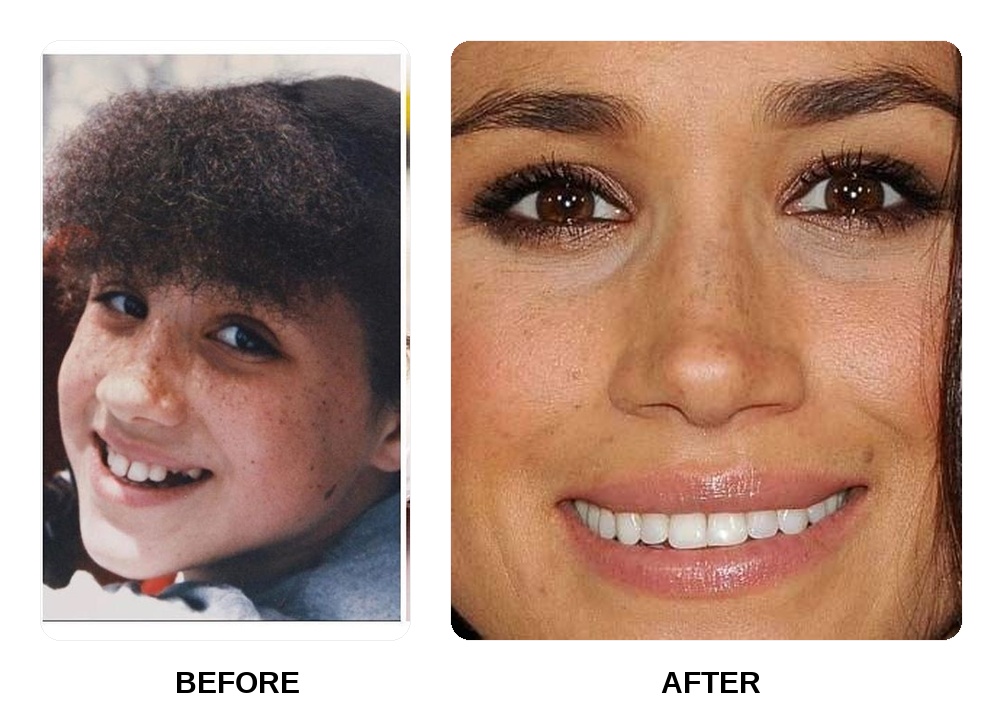 Meghan Markle white teeth