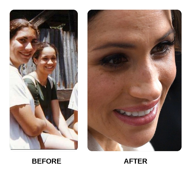 Are Meghan Markle teeth asymmetrical?
