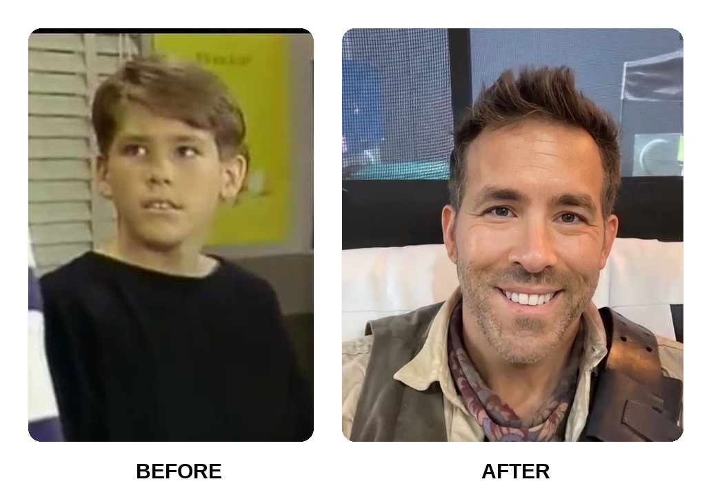 Did Ryan Reynolds get his teeth done?