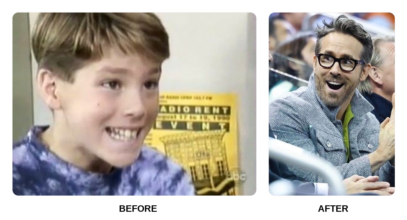 What happened to Ryan Reynolds teeth?