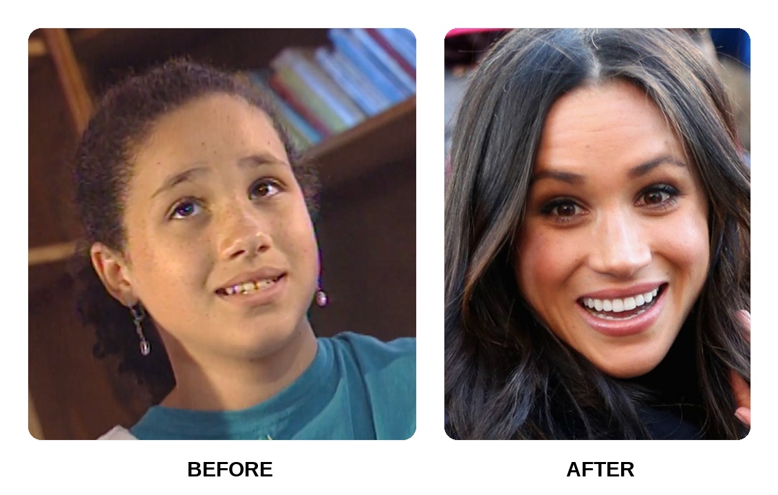 What did Meghan Markle’s teeth look like in her youth?