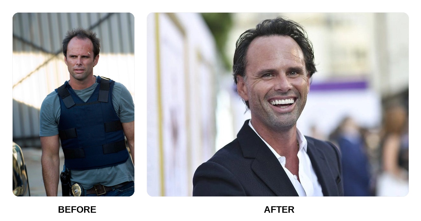 What happened to Walton Goggins teeth?