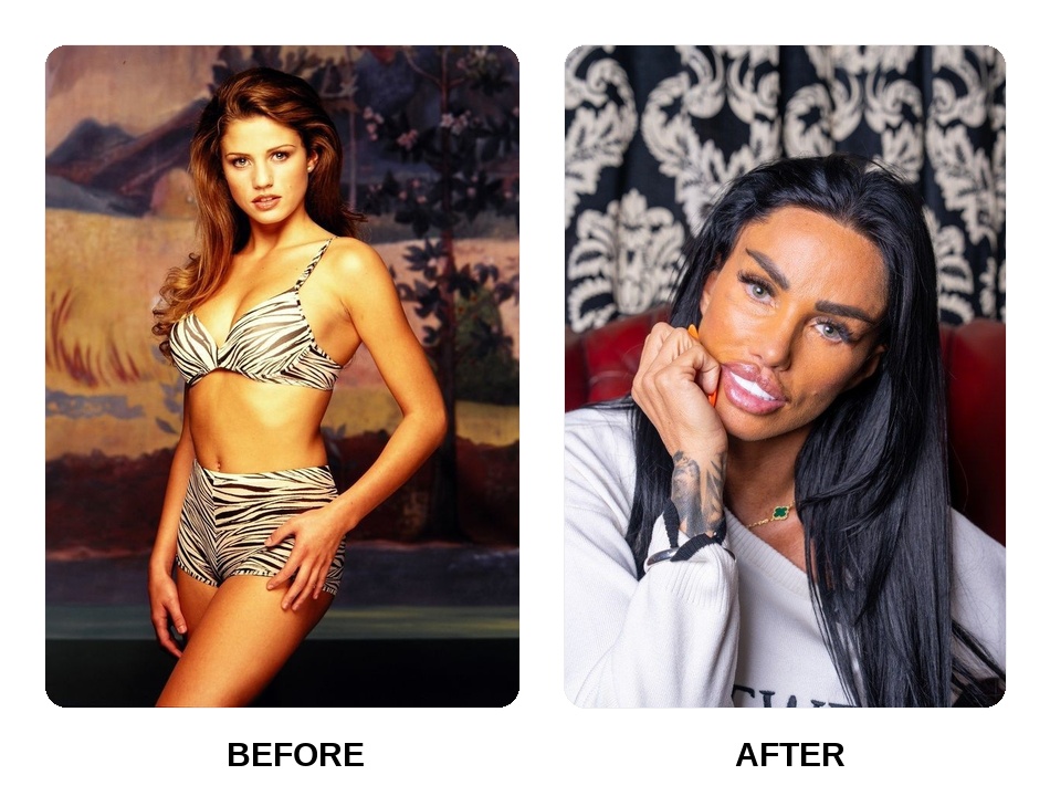 Katie Price new teeth before and after