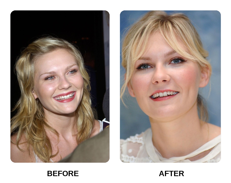 Kirsten Dunst teeth: Kirsten Dunst new teeth before and after