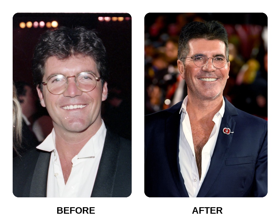 Simon Cowell teeth before and after