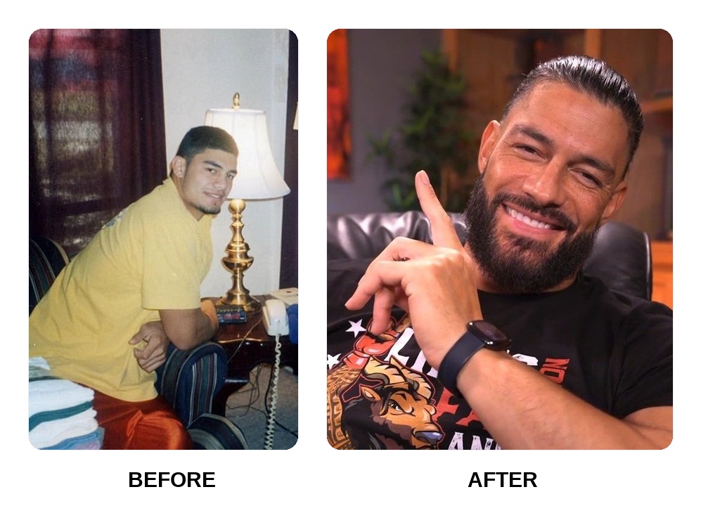 Roman Reigns teeth: Roman Reigns new teeth before and after