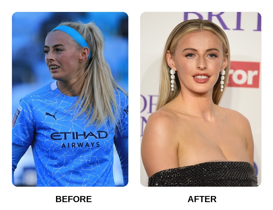 Chloe Kelly teeth: Chloe Kelly new teeth before and after