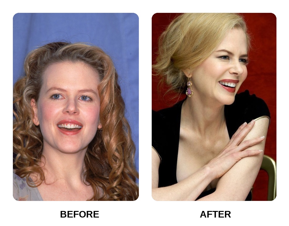 Nicole Kidman teeth: Nicole Kidman new teeth before and after