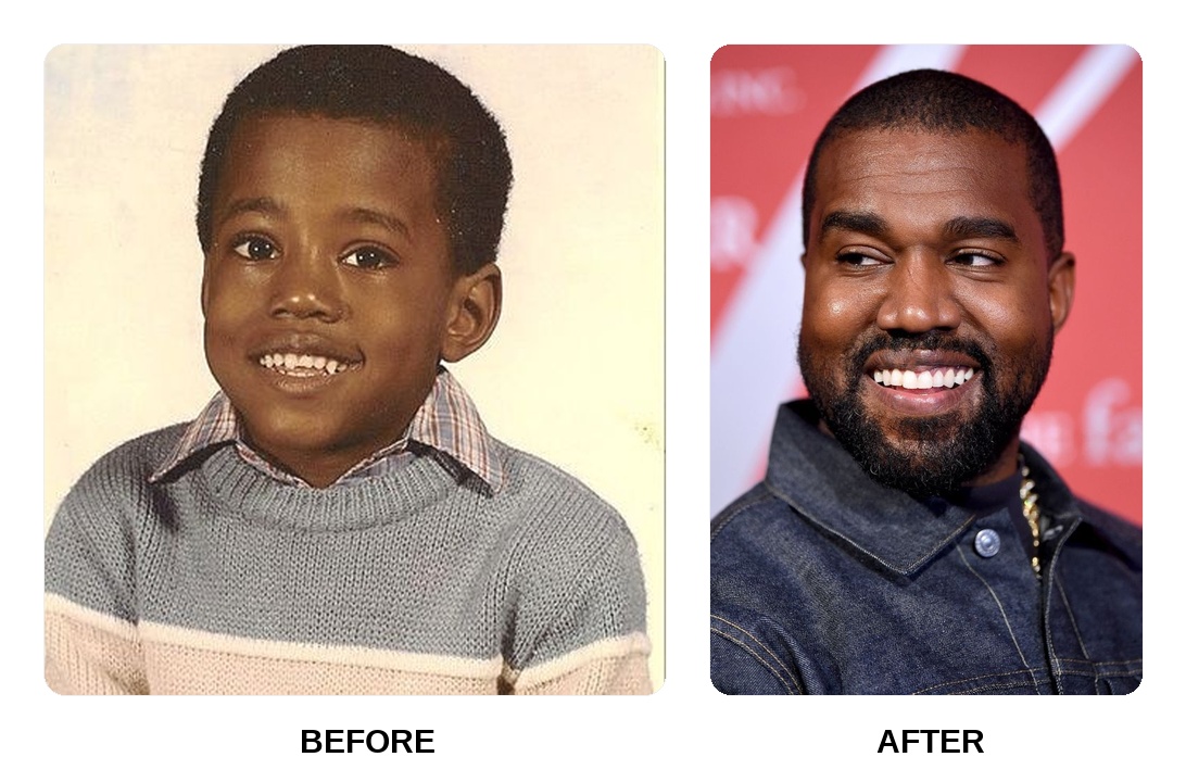 Kanye West teeth: Kanye West new teeth before and after