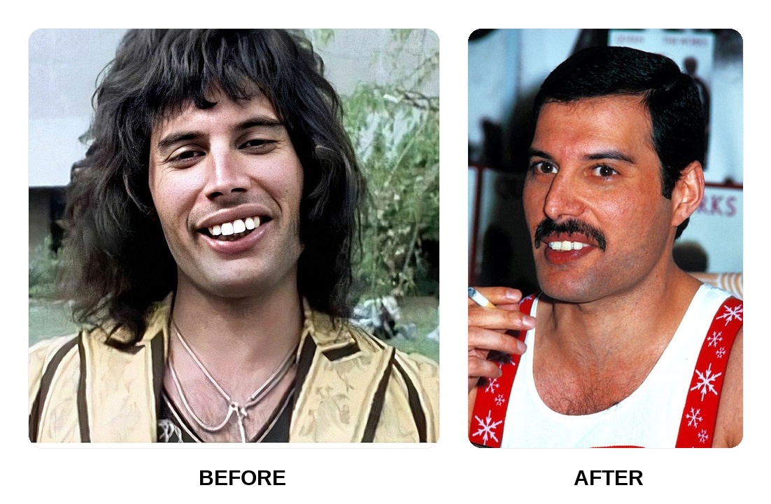 Freddie Mercury teeth: Freddie Mercury new teeth before and after