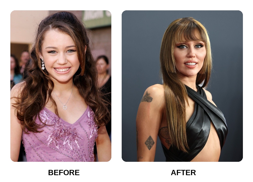 Miley Cyrus Teeth: Miley Cyrus New Teeth Before and After