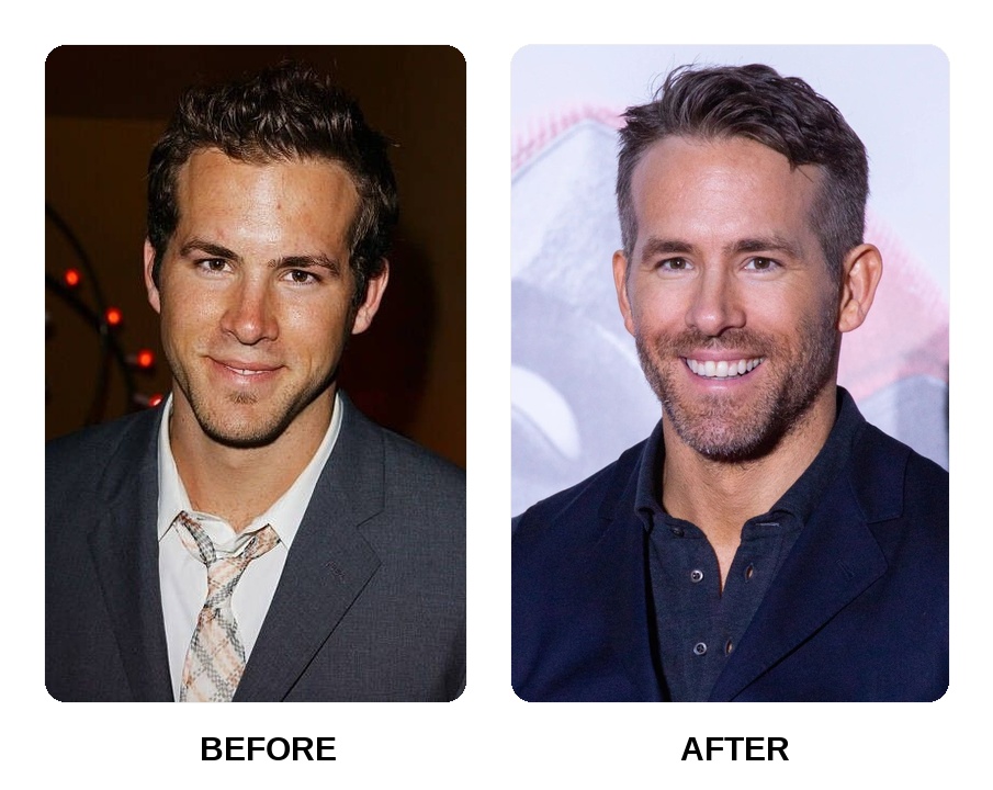 Ryan Reynolds teeth: Ryan Reynolds new teeth before and after