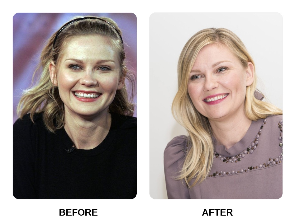 Kirsten Dunst decaying teeth