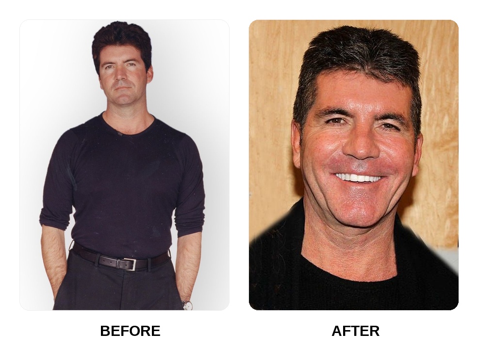 Simon Cowell teeth in his youth