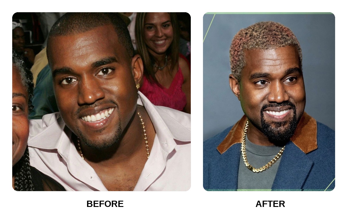 Kanye West decaying teeth