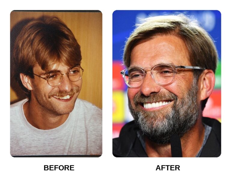 Jurgen Klopp Teeth Before And After What Happened In His Jurgen Klopp Teeth Before And After What Happened In His