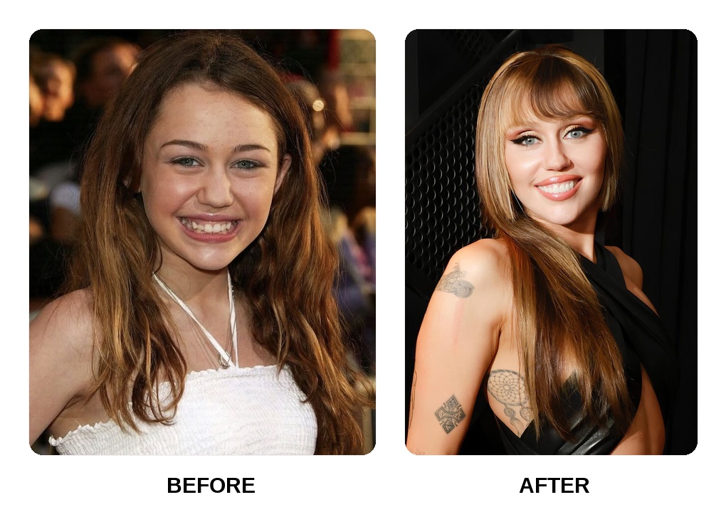 Miley Cyrus decaying teeth