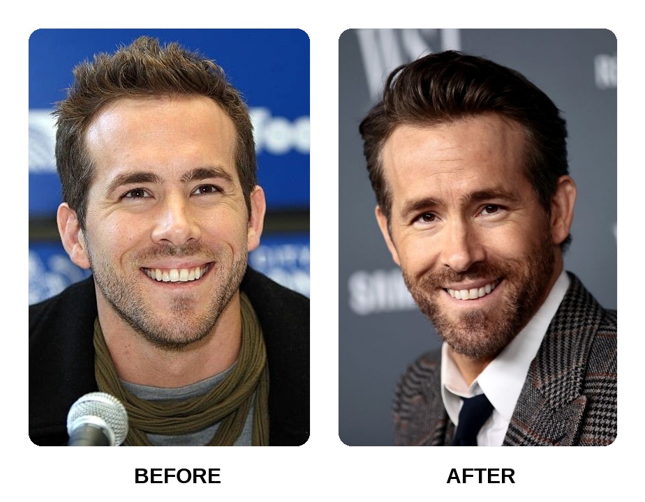 Ryan Reynolds decaying teeth