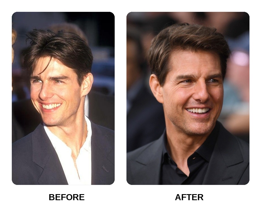 Are Tom Cruise Teeth Showing Signs of Decay?