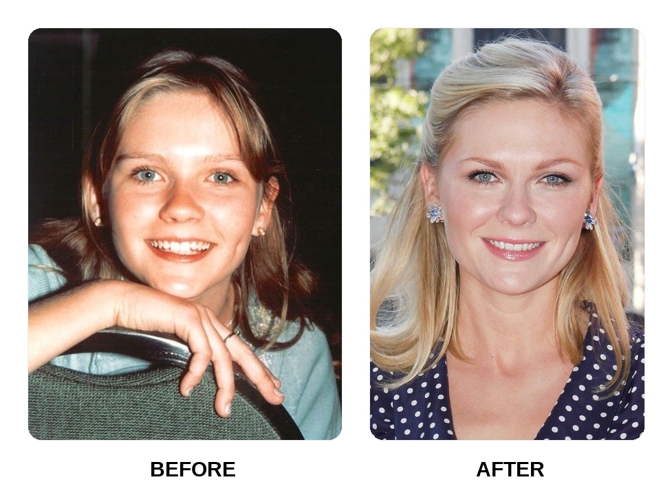 Kirsten Dunst teeth in her youth