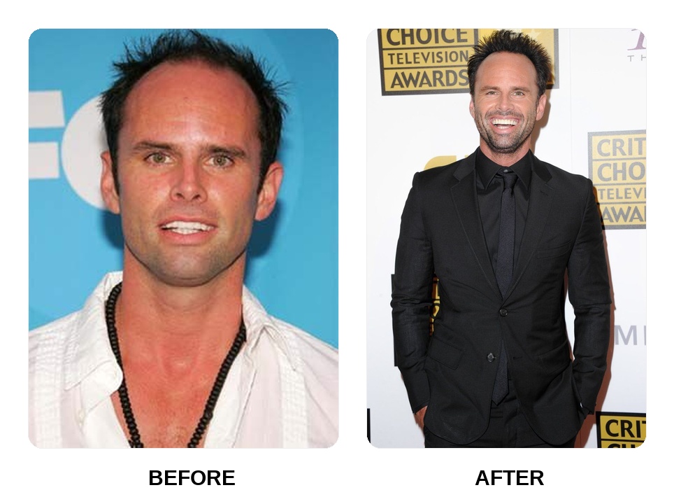 Did Walton Goggins get his teeth done?