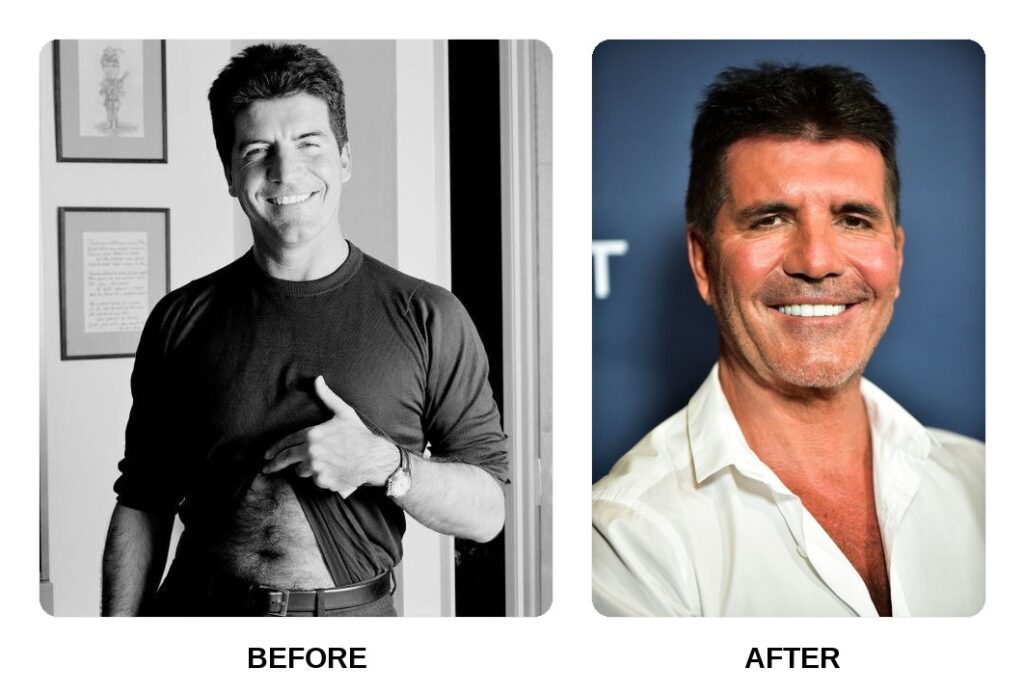 Simon Cowell Teeth Before and After What Happened in His