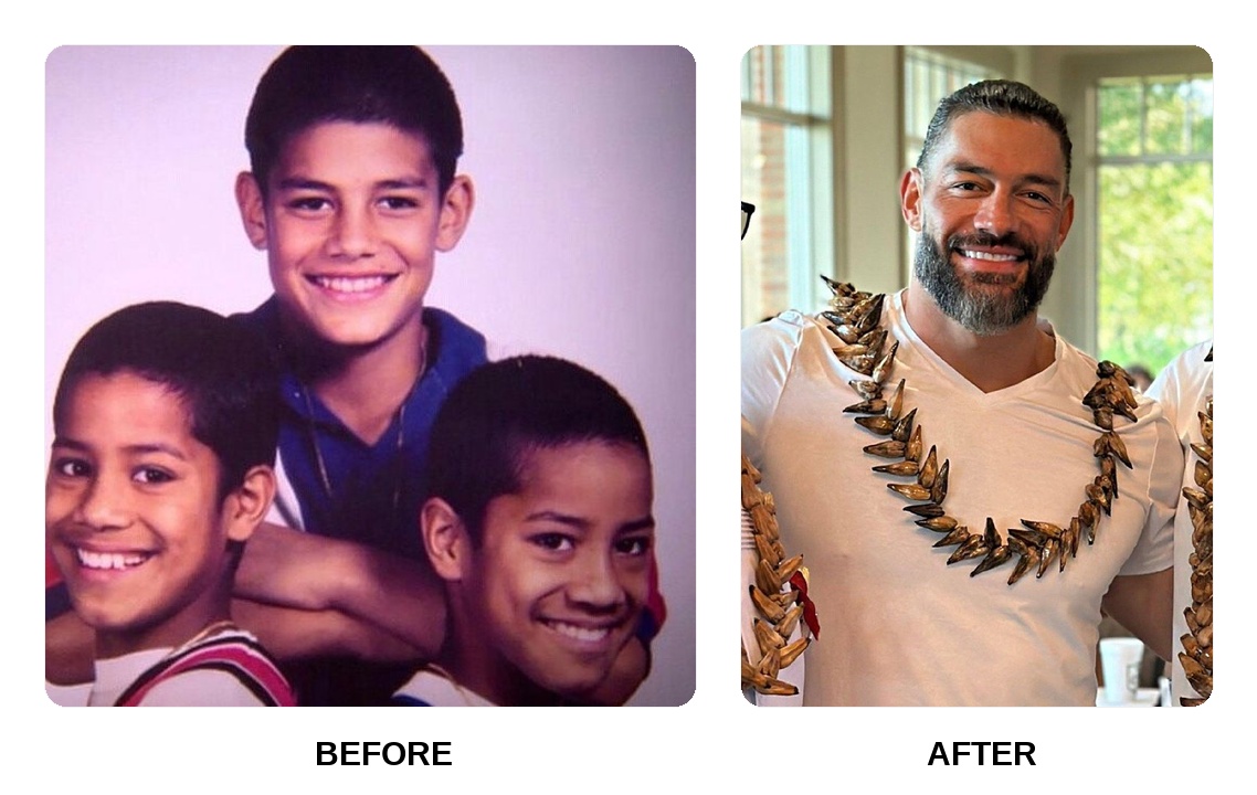 Did Roman Reigns get his teeth done?
