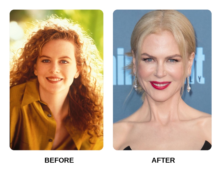 Nicole Kidman front teeth