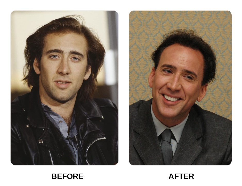 What happened to Nicolas Cage teeth?