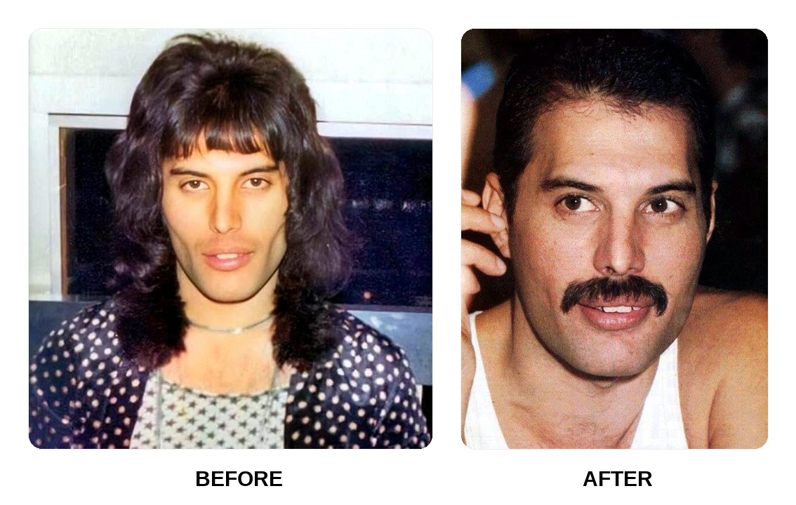 Did Freddie Mercury get his teeth done?