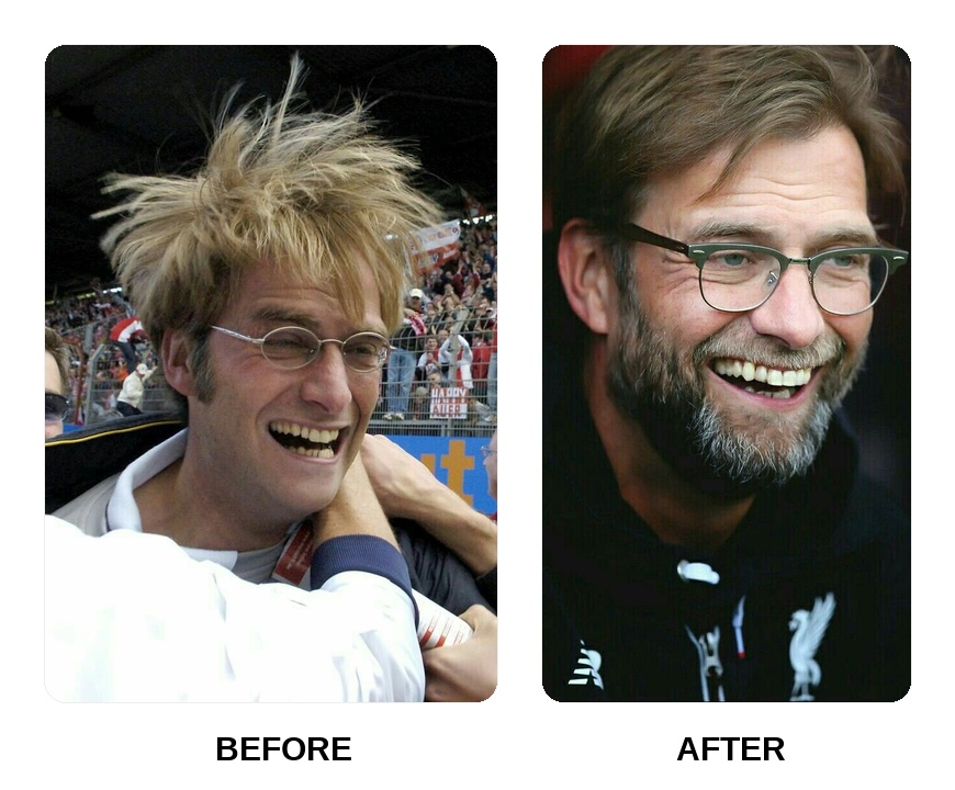 Did Jurgen Klopp get his teeth done?