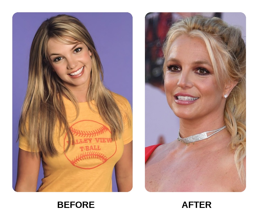 Did Britney Spears get her teeth done?