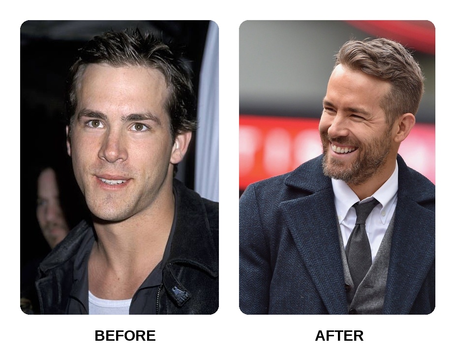 Ryan Reynolds teeth in his youth