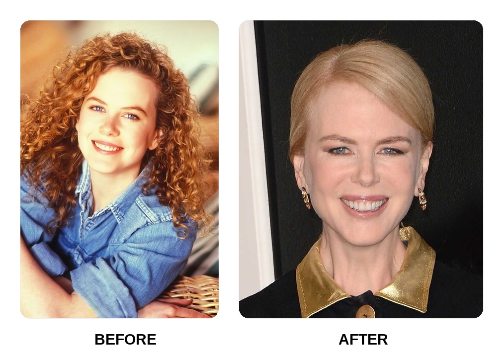 Did Nicole Kidman get her teeth done?
