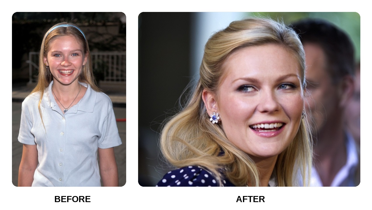 What happened to Kirsten Dunst teeth?