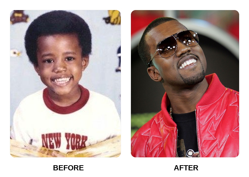 Does Kanye West have veneers on his teeth?