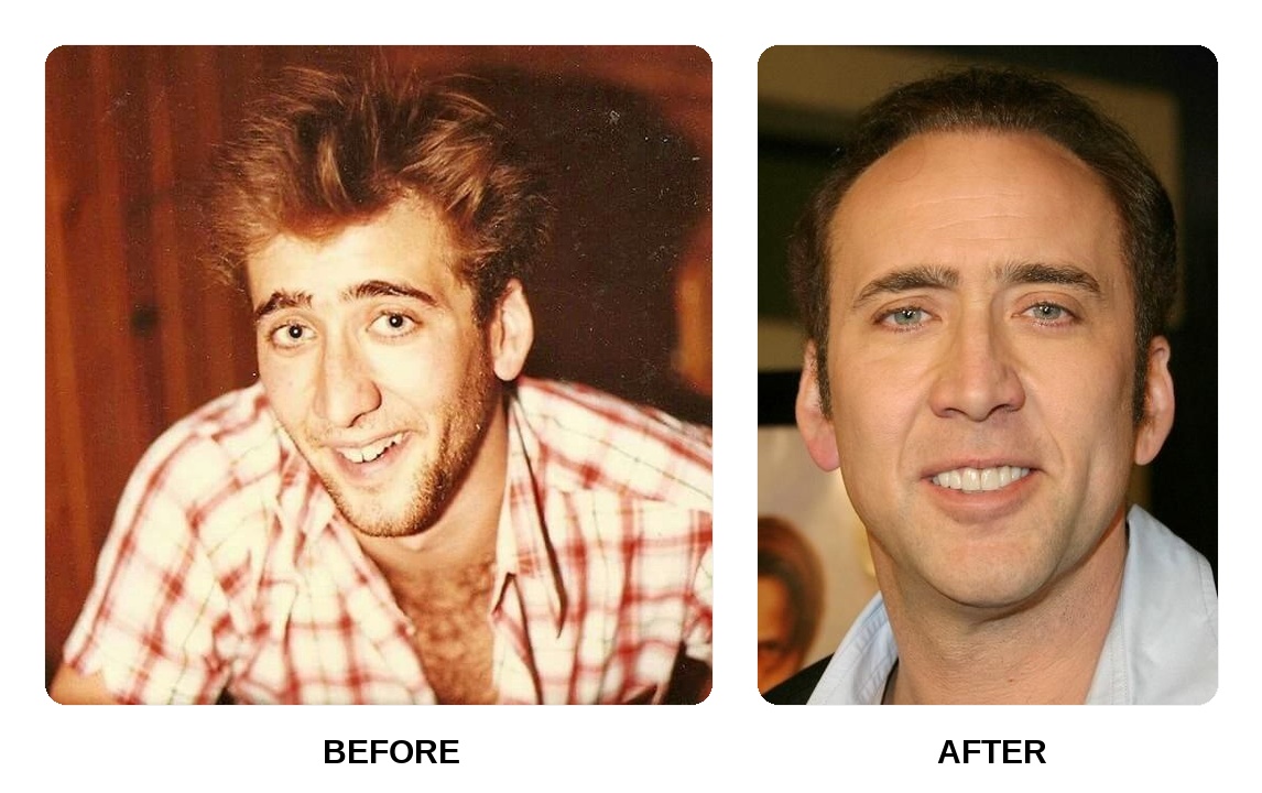 How did Nicolas Cage fix his teeth?