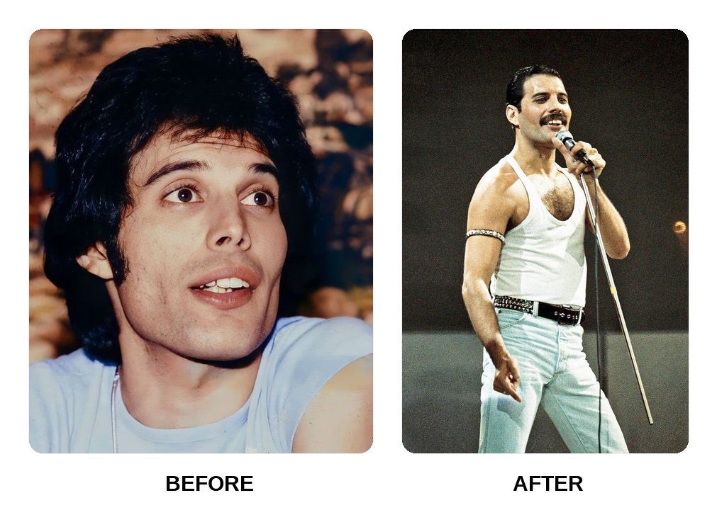 How did Freddie Mercury fix his teeth?