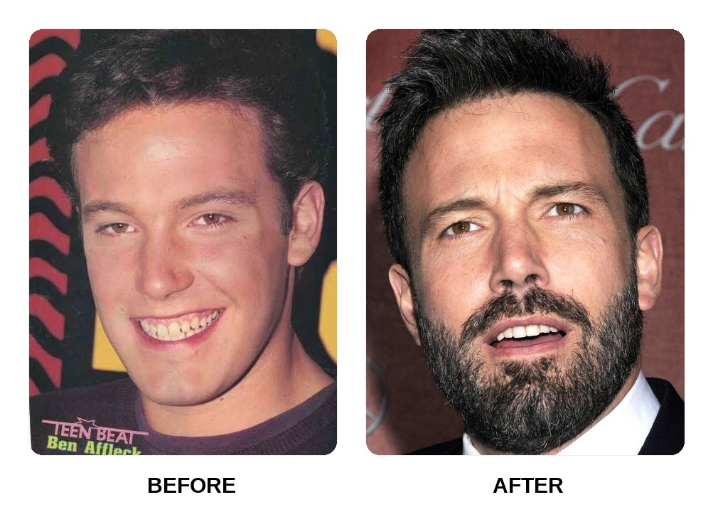 Does Ben Affleck have veneers on his teeth?